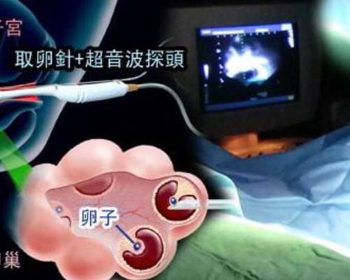 杭州私人代孕网站,什么情况要做试管婴儿啊-杭州哪家医院供卵_试管应该喝含量
